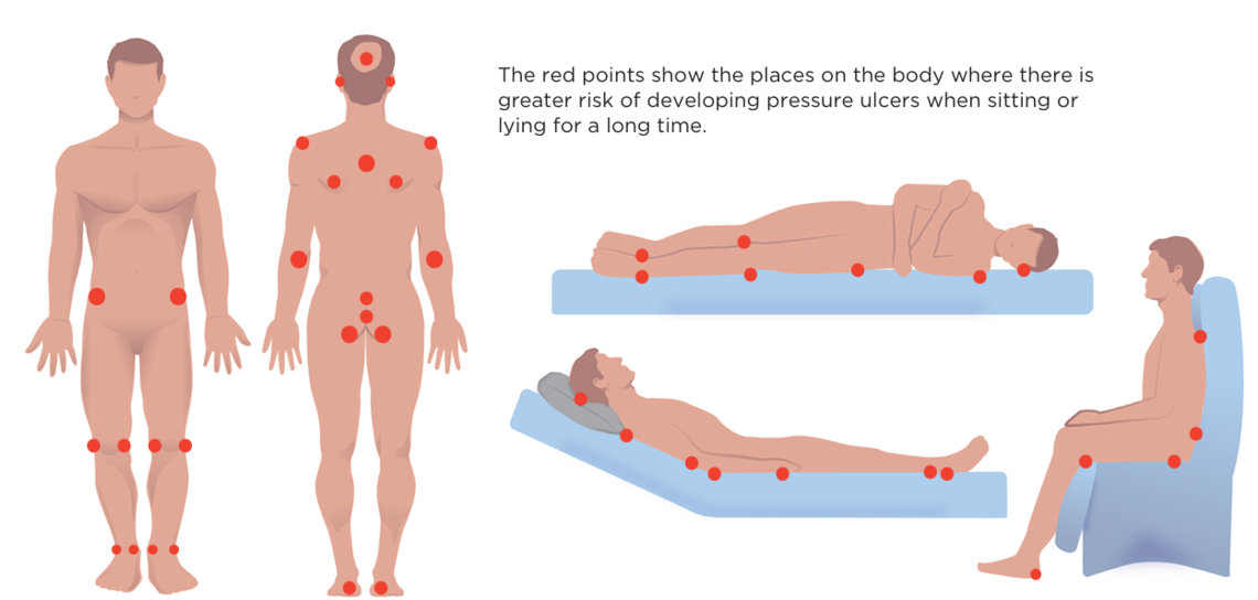 English image Preventing pressure sores