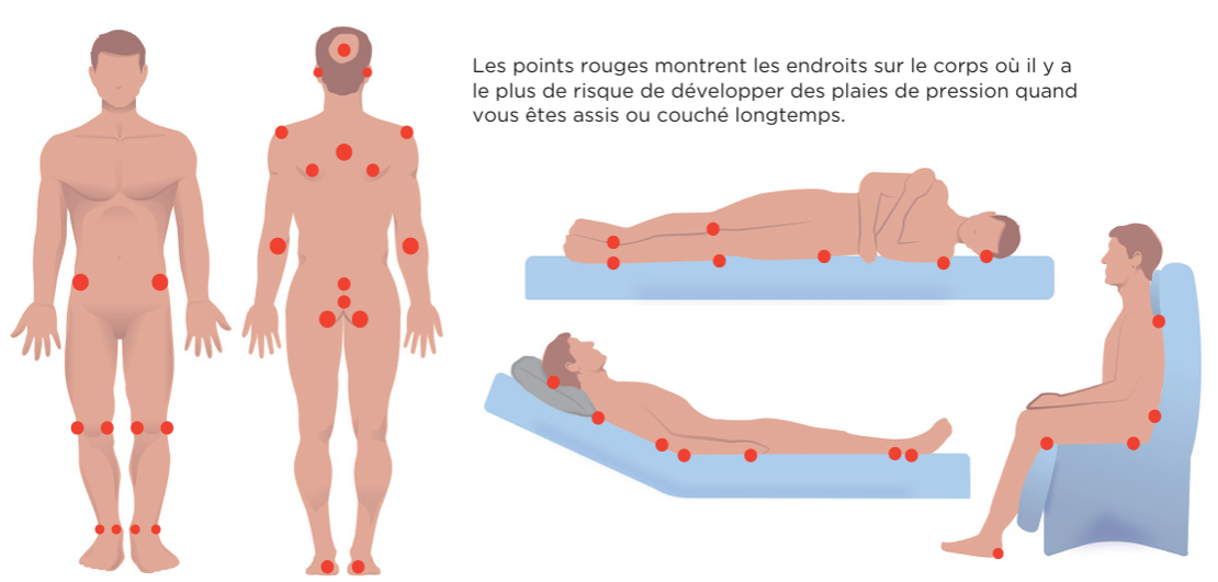 Image des zones à plaie de pression sur le corps